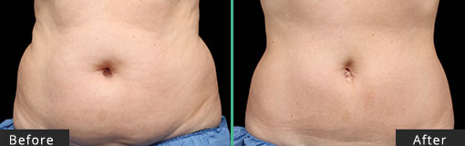 Female Abdomen CoolSculpting Before and After