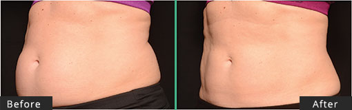 Female Abdomen CoolSculpting Before and After