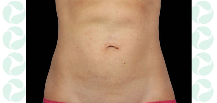 Female Abdomen After CoolSculpting